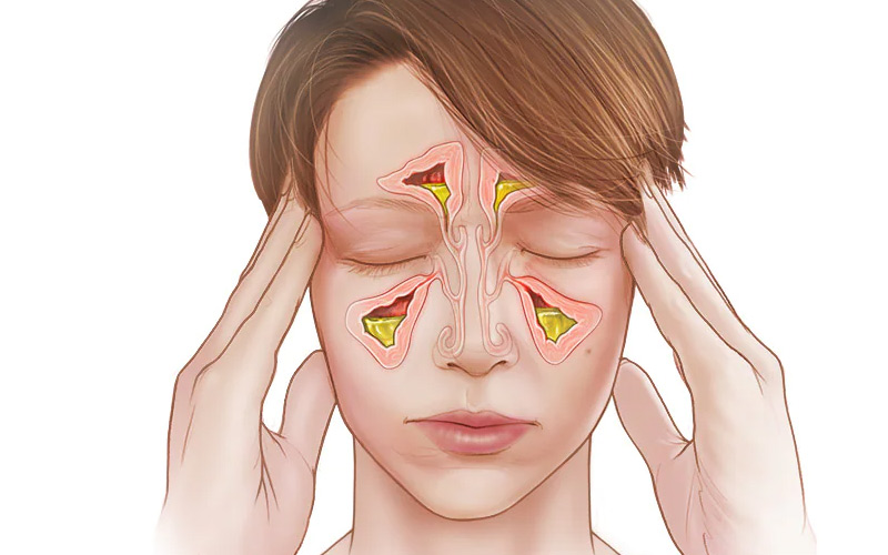 bệnh viêm xoang có chữa được không