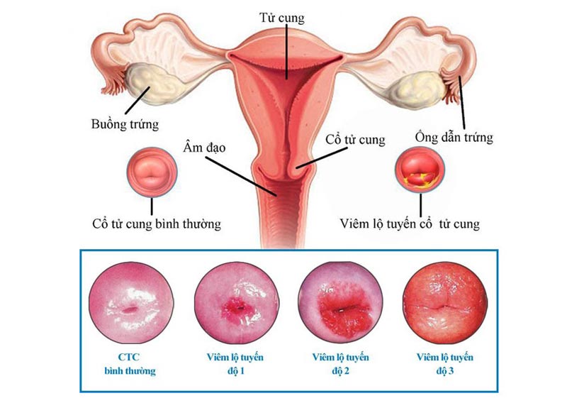 viêm lộ tuyến cổ tử cung