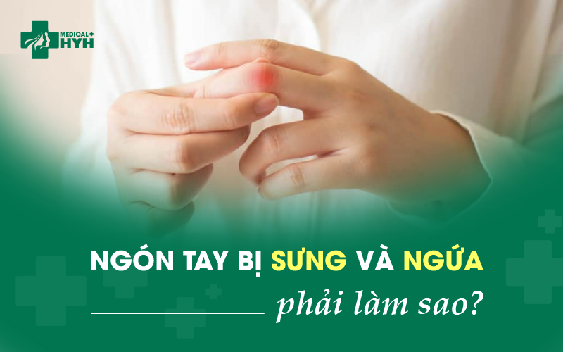 ngón tay bị sưng phù và ngứa